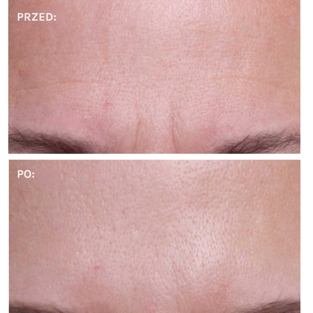 Wrinkles Schminkles Brow, Frown & Bunny Lines Wrinkle Patches Wrinkles Schminkles Brow, Frown & Bunny Lines - porównanie wyglądu skóry czoła przed i po zastosowaniu silikonowych płatków na linie mimiczne.