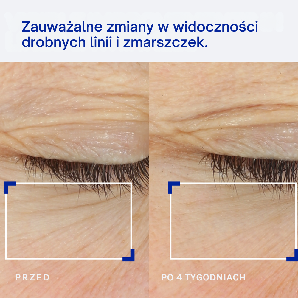 IOPE Expert Retinol Reti-Jection Serum 2% IOPE Expert Retinol Reti-Jection Serum 2% - porównanie skóry przed i po 4 tygodniach stosowania, pokazujące zmiany w widoczności drobnych linii i zmarszczek.
