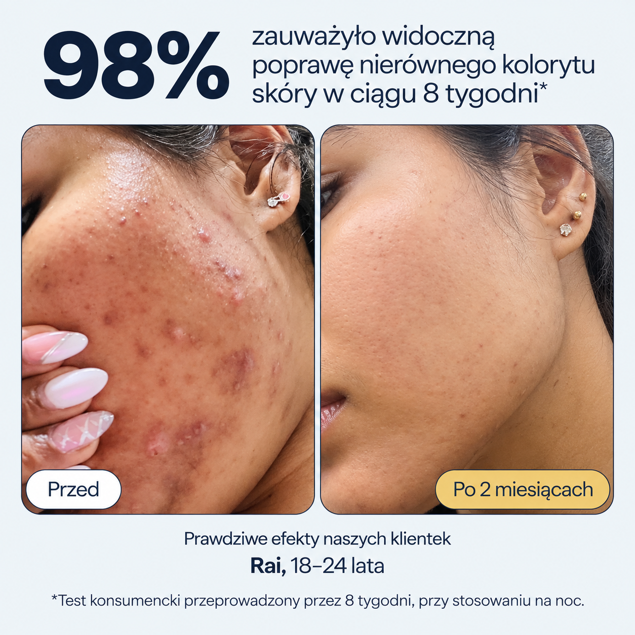5 Remedy Science REMEDY for Dark Spots - efekty przed i po 8 tygodniach stosowania serum na przebarwienia, pokazujące poprawę wyglądu nierównego kolorytu i śladów pozapalnych.