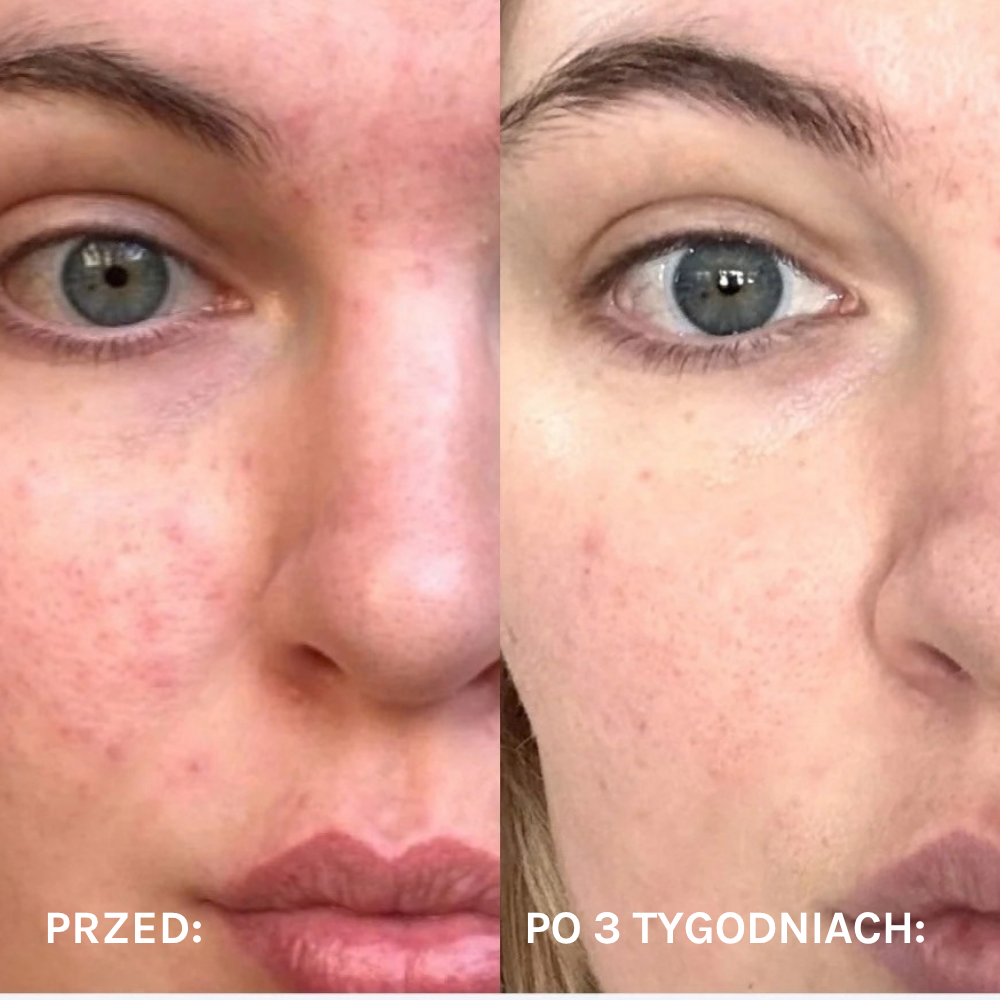 Renew Brightening Boosting Serum (4) Moonbow Renew Brightening Boosting Serum - porównanie wyglądu skóry przed i po 3 tygodniach stosowania serum rozświetlającego.