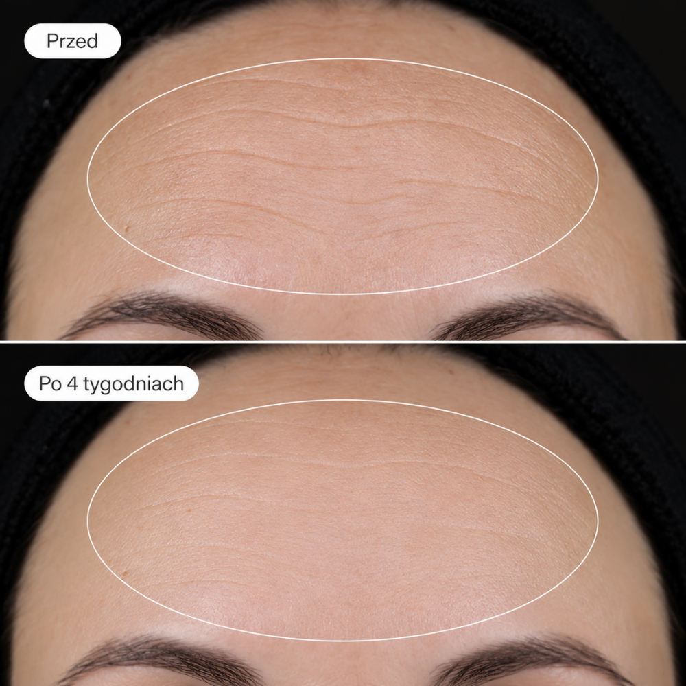 Skinfix Ceramide Prime Whipped Cream Skinfix Ceramide Prime Whipped Cream - porównanie skóry czoła przed stosowaniem kremu i po 4 tygodniach, pokazujące gładszy, bardziej miękki i mniej przesuszony wygląd skóry oraz mniejszą widoczność drobnych linii.