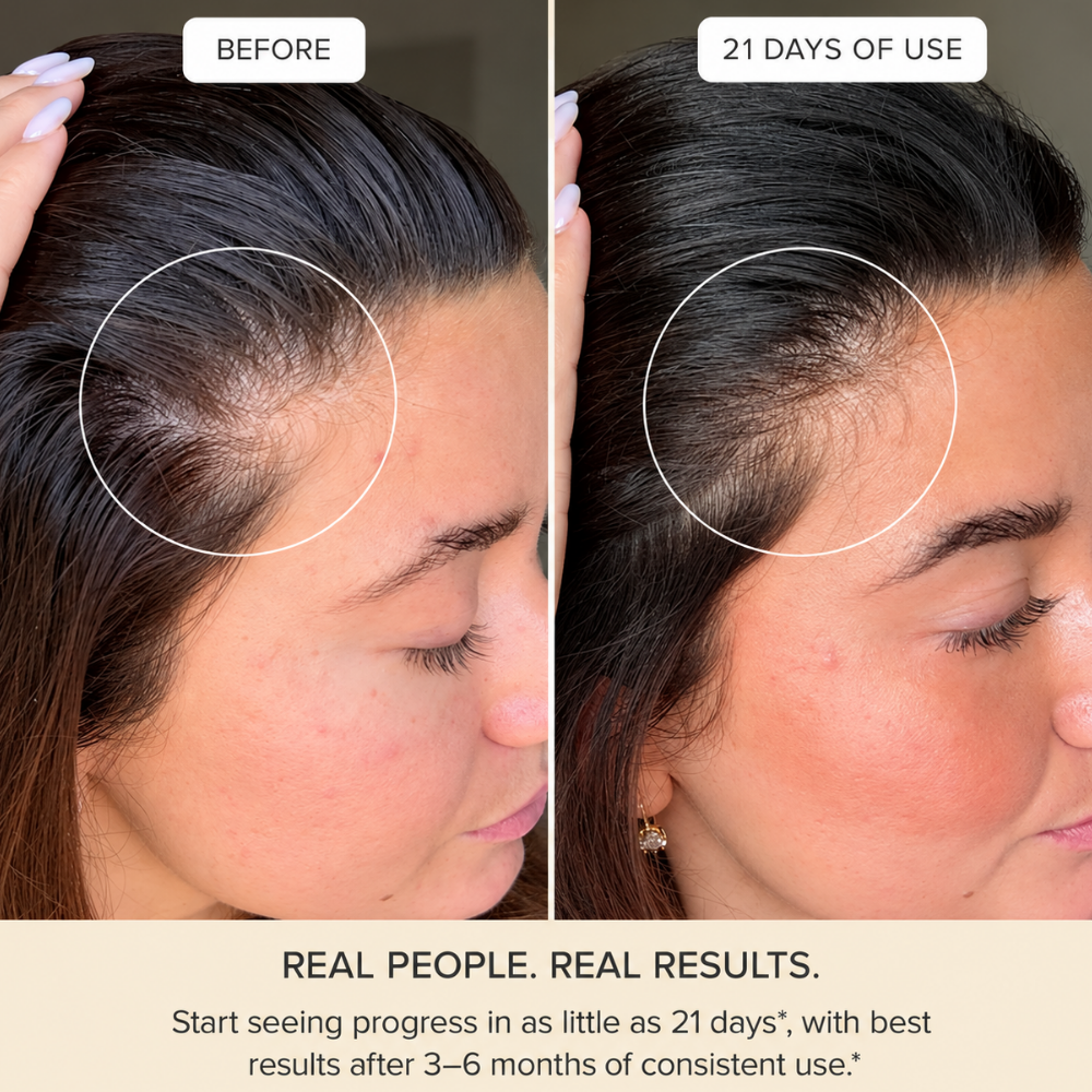 Arrae Hair Protein Hair Growth Stick Packs Lemonade (5) Arrae Hair Protein Hair Growth Stick Packs Lemonade - grafika porównawcza „przed i po 21 dniach stosowania” przedstawiająca linię włosów kobiety z zaznaczonymi obszarami przy skroniach. Zdjęcia ilustrują deklarowaną poprawę gęstości włosów, a producent wskazuje, że najlepsze rezultaty można zaobserwować po 3-6 miesiącach regularnego stosowania.
