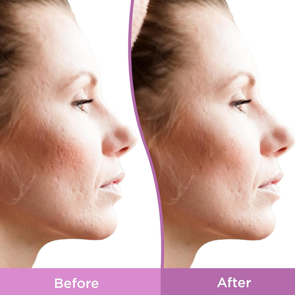 Differin Resurfacing Acne Scar Treatment Gel for Face (3) Differin Resurfacing Scar Gel - porównanie wyglądu skóry twarzy przed i po stosowaniu żelu wygładzającego. Grafika przedstawia zmiany w widoczności blizn potrądzikowych i nierówności skóry na policzku.