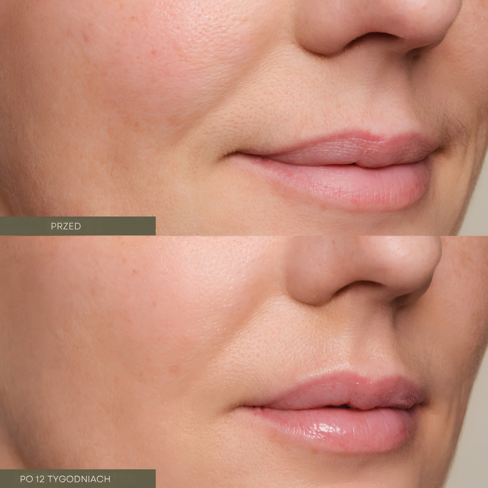 Oak Essentials Firming Plant Peptide Serum (4) Efekt przed i po 12 tygodniach stosowania Oak Essentials Firming Plant Peptide Serum - porównanie wyglądu skóry twarzy, pokazujące gładszą, bardziej jędrną i pełniejszą skórę po kuracji.