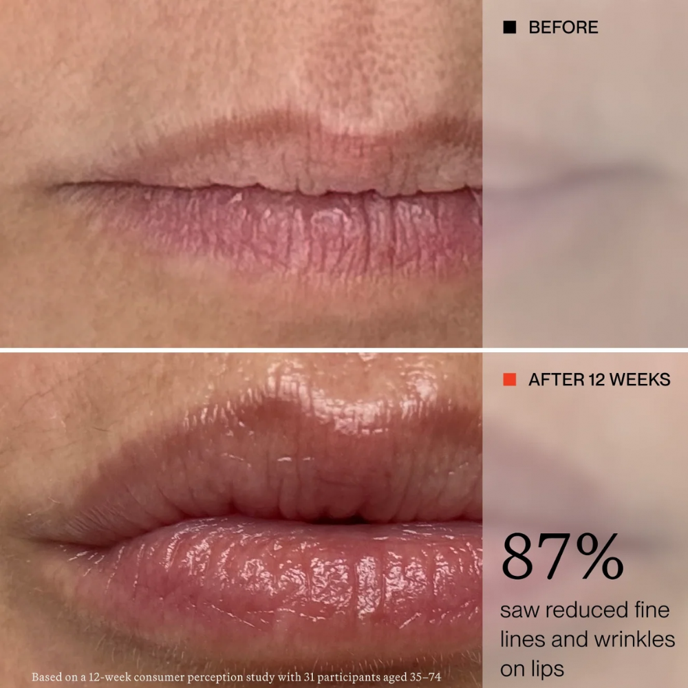 One Skin Os 01 Lip Peptide Lip Mask (7) ONE SKIN Lip Mask - porównanie wyglądu ust przed rozpoczęciem stosowania i po 12 tygodniach pielęgnacji maską do ust. Widocznie gładsze, bardziej nawilżone i pełniejsze usta z mniej zaznaczonymi drobnymi liniami. 87% uczestników badania zauważyło zmniejszenie widoczności drobnych linii i zmarszczek na ustach. Wyniki 12-tygodniowego badania konsumenckiego z udziałem 31 osób w wieku 35-74 lat.