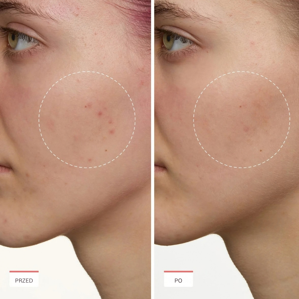 Peach Slices Super Fade Discoloration Moisturizer (5) Porównanie efektu przed i po pielęgnacji kremem Peach Slices Super Fade Discoloration Moisturizer. Zbliżenie na policzek modelki z zaznaczonym obszarem przebarwień i śladów po niedoskonałościach. Po prawej stronie widoczna jest skóra o bardziej wyrównanym kolorycie i mniej widocznych zaczerwienieniach.
