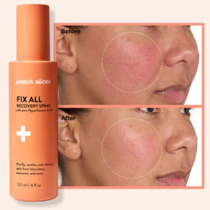 Zbliżenie na efekty działania Peach Slices Fix All Recovery Spray – widoczna redukcja zaczerwienienia skóry policzka po 7 dniach stosowania. Produkt z kwasem podchlorawym łagodzi podrażnienia i przywraca równowagę cery.